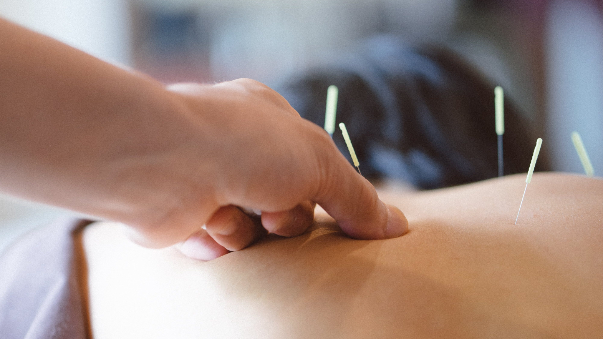 Acupuncture